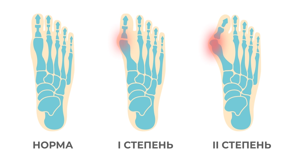 halus_valgus3.png