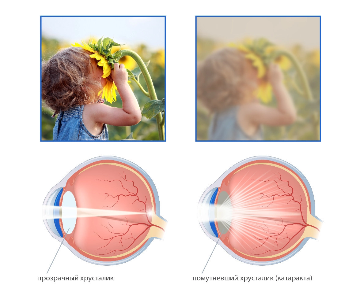 cataract_rus.jpg