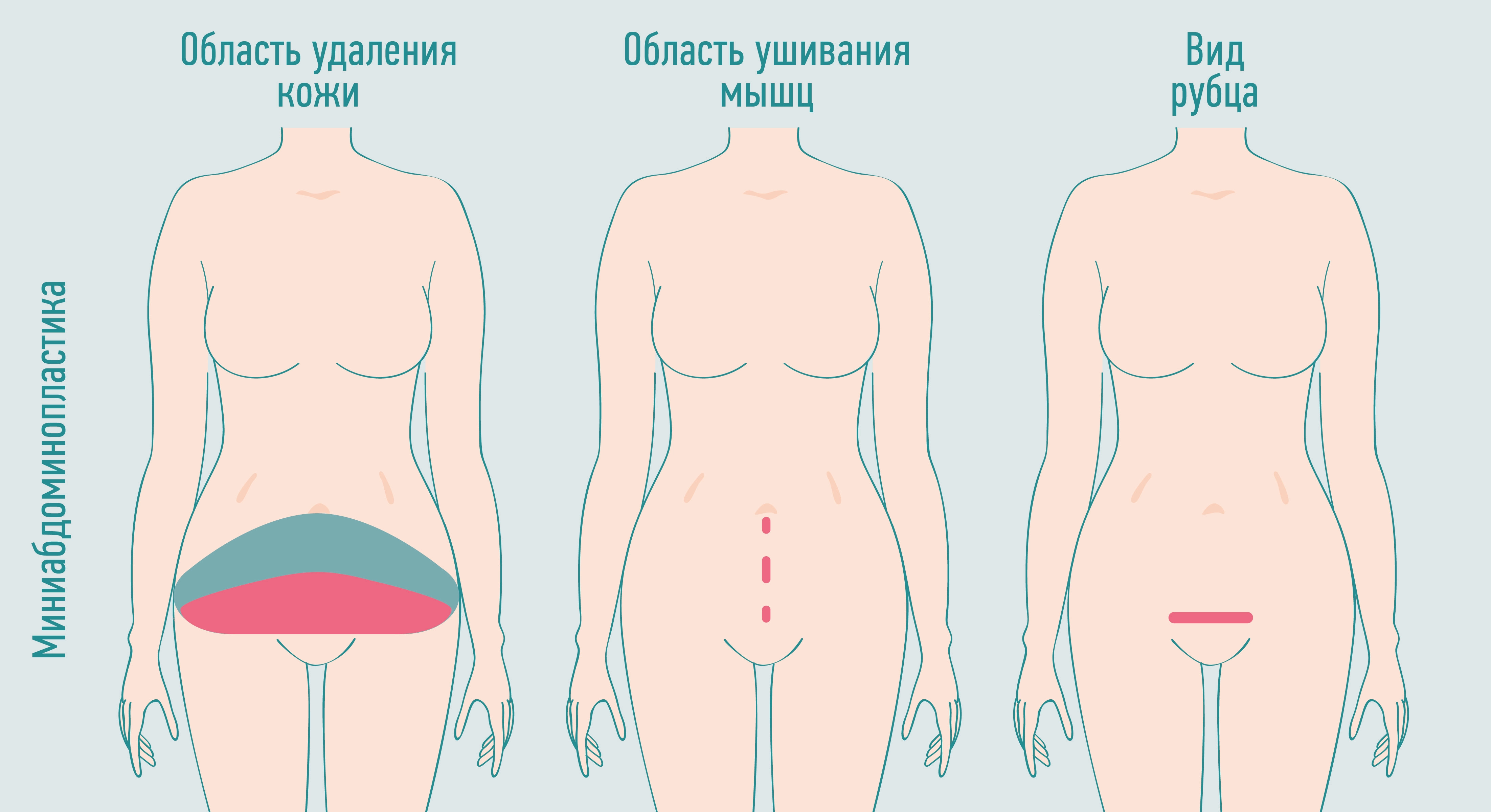 миниабдоминопластика